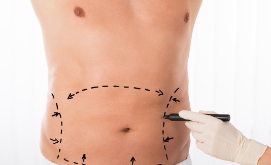 Cada vez son más los hombres que se someten a la liposucción debido a que ofrece varias ventajas muy marcadas.