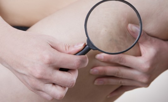 Celulitis
