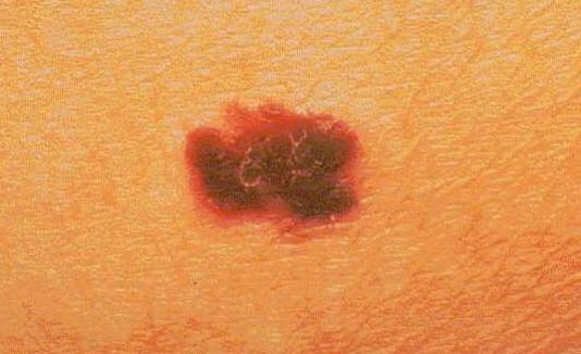 Melanoma