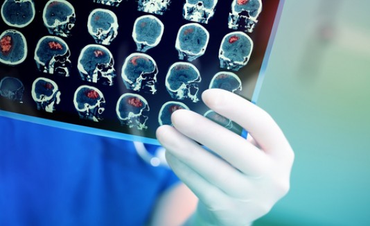 cáncer de cerebro